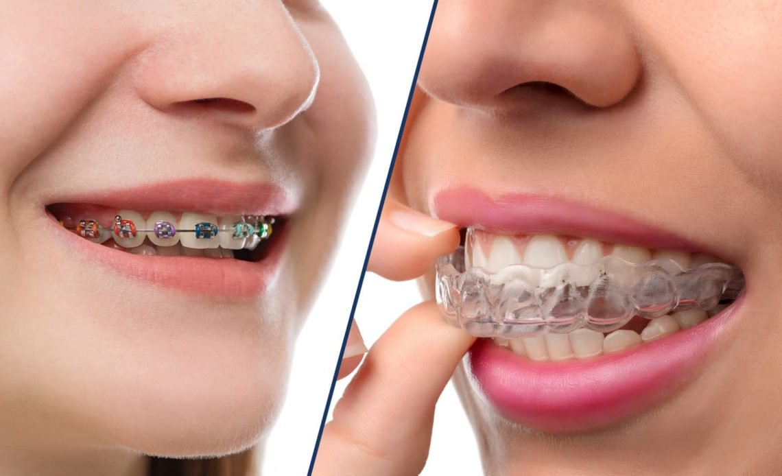 Răng thưa nên làm gì ? 3 biện pháp cải thiện răng thưa hiệu quả nhất